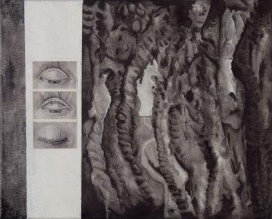 Scoliosis